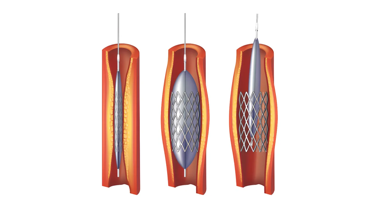 Stent