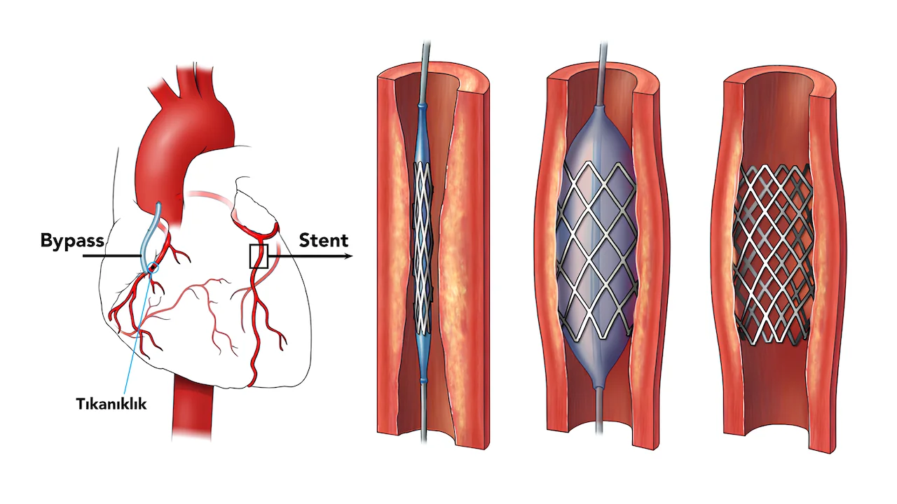 Stent mi Bypass mı?