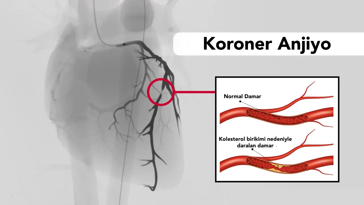 Koroner Anjiyografi (Anjiyo)
