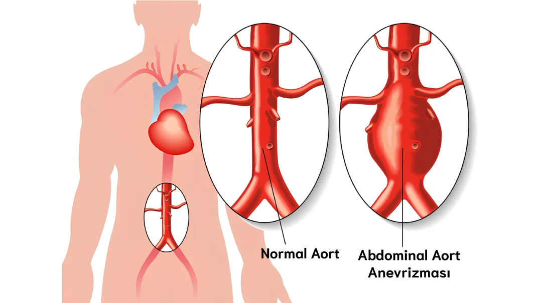 Aort anevrizmasi