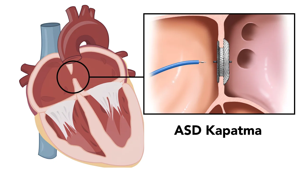 Atriyal Septal Defekt (ASD)