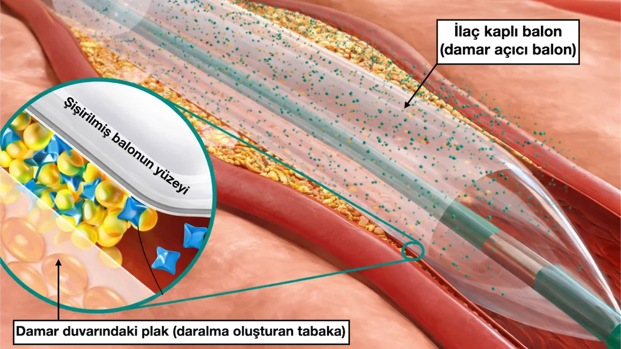 İlaçlı Balon Tedavisi