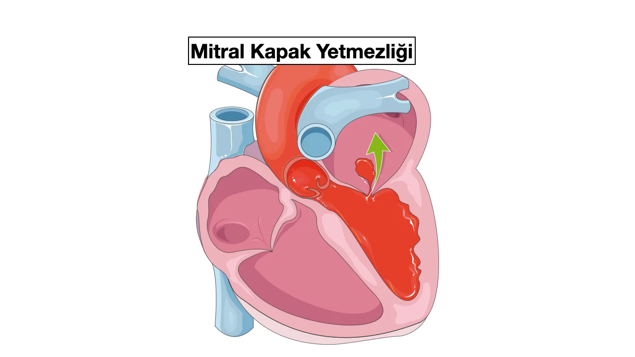 Mitral Kapak Yetmezliği