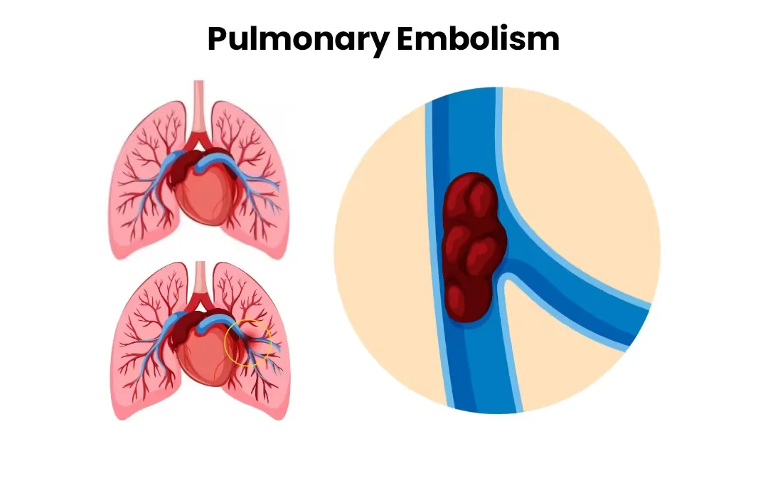 Pulmoner emboli (Akciğer embolisi)