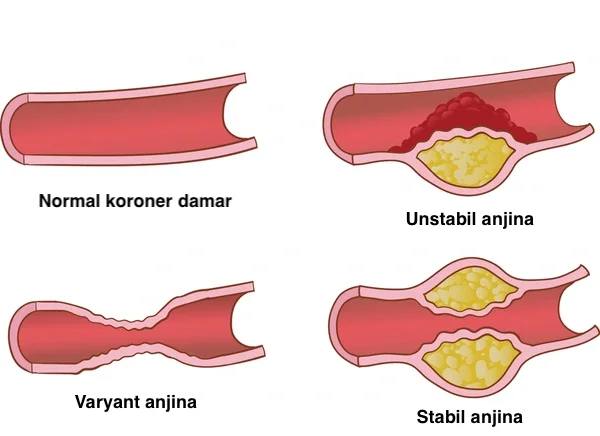 Anjina pektoris (Göğüs ağrısı)