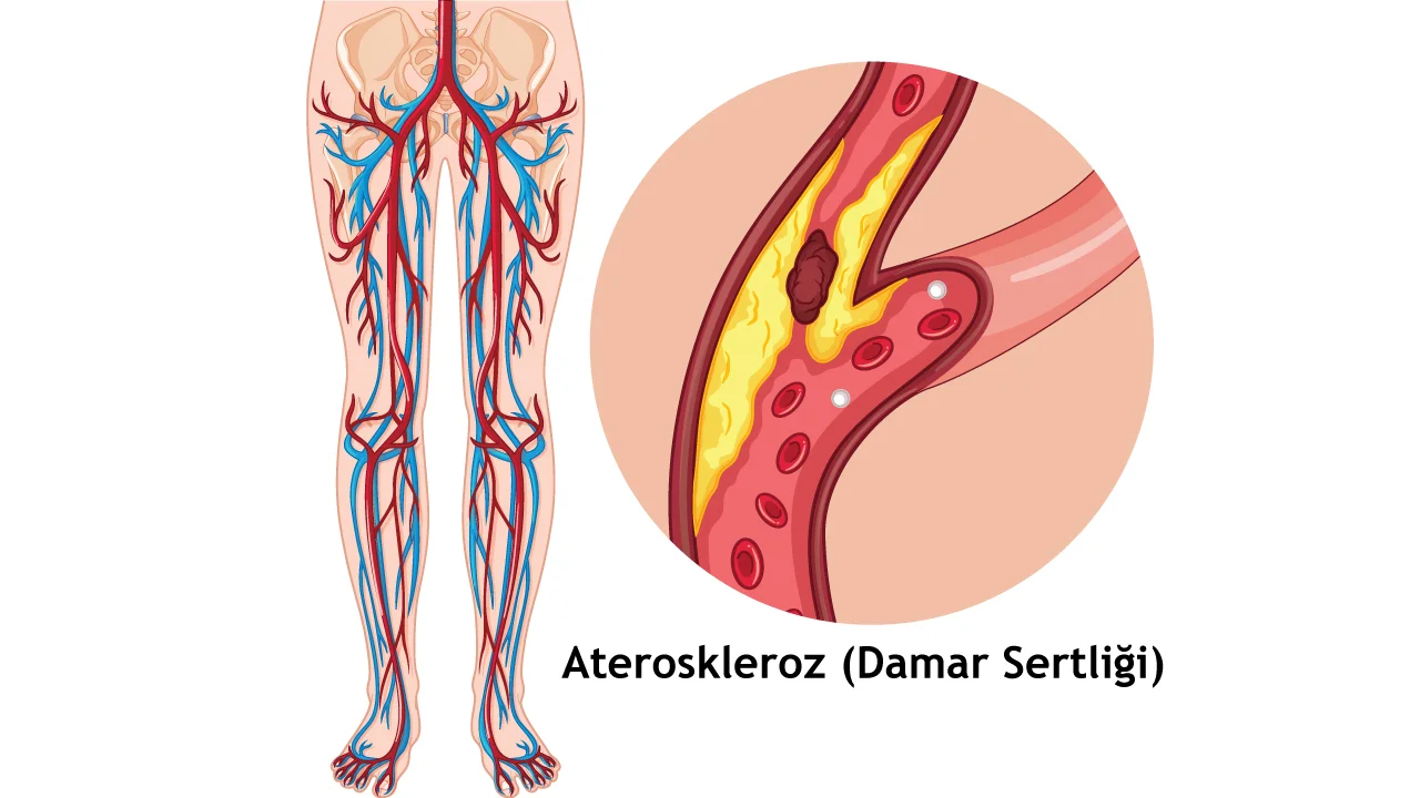 Periferik Arter Hastalığı